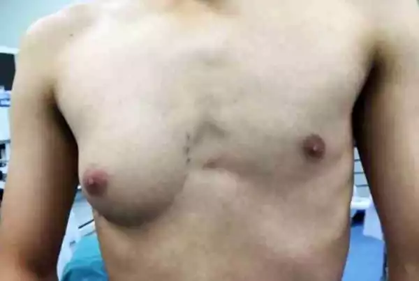 Omg! See The Man Who Mysteriously Grew A Breast Like A Girl On The Right Side Of His Chest (Photos)